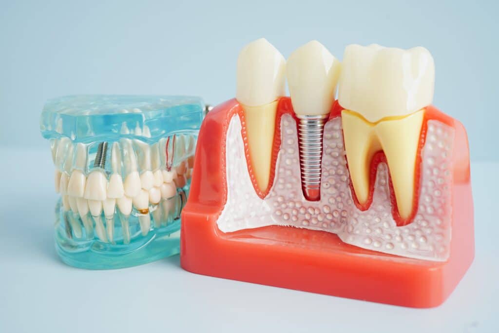 dental implants near me