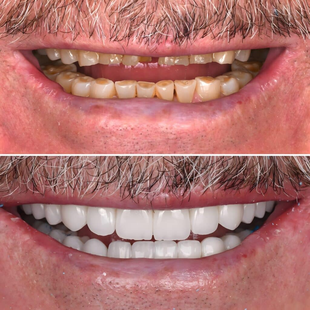 Cosmetic smile makeover morgan